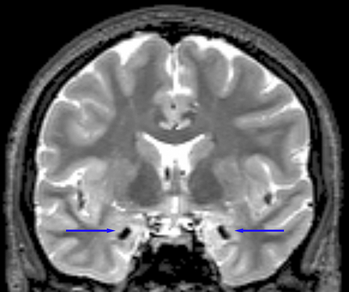 Resonancia magnética de una persona con enfermedad de Urbach-Wiethe. Las flechas indican calcificación bilateral en la amígdala basolateral, una región del cerebro implicada en el aprendizaje del miedo y la toma de decisiones sociales. Foto: David Terburg.